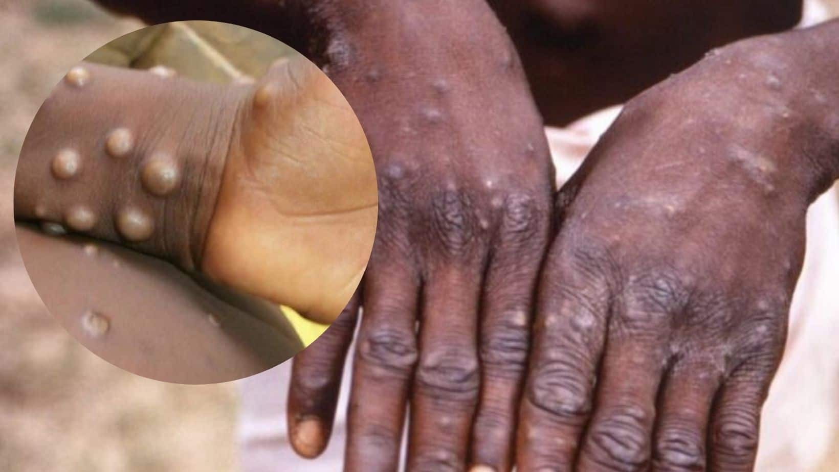 Rare Monkeypox Virus Detected In US For The First Time: How You Can Catch It And Symptoms It Can Cause